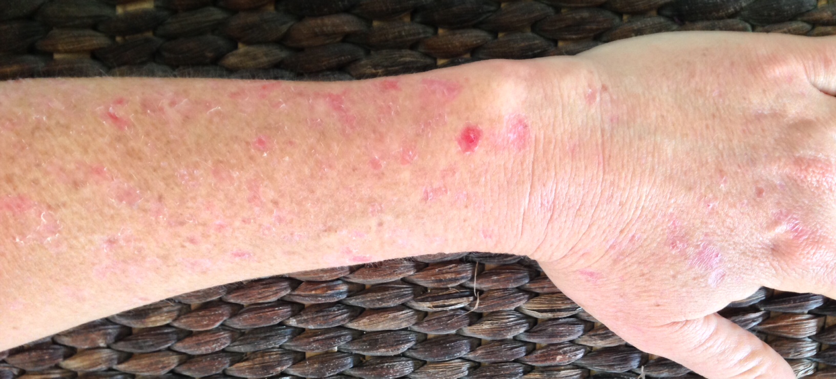 Managing DSAP with Tazarotene and Fluorouracil